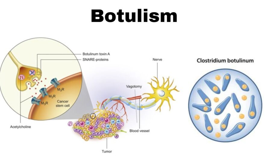 Botulism Outbreak: 5 Devastating Effects and Critical Prevention Tips