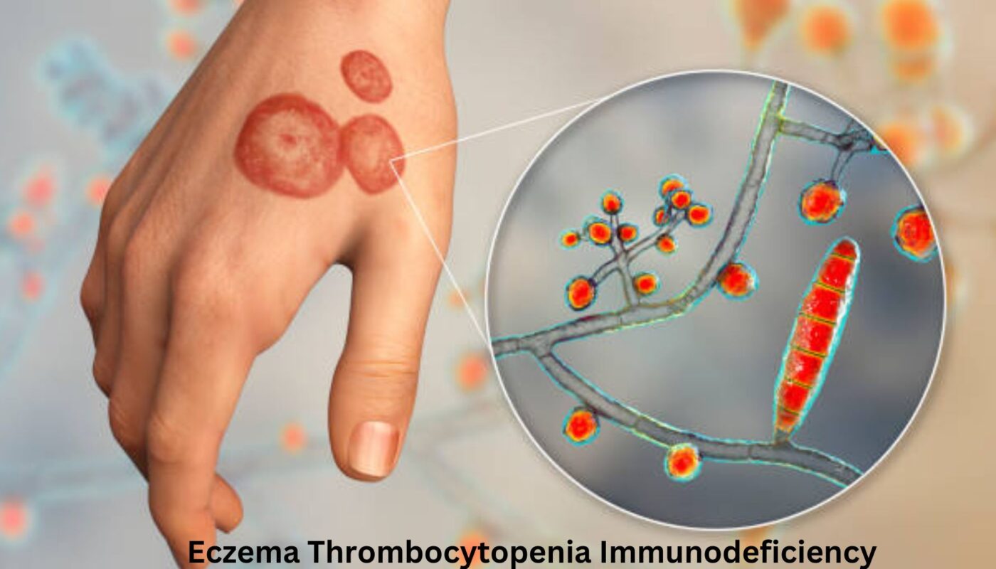 Eczema Thrombocytopenia Immunodeficiency