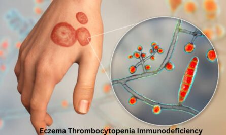 Eczema Thrombocytopenia Immunodeficiency
