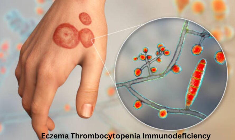 Eczema Thrombocytopenia Immunodeficiency Syndrome