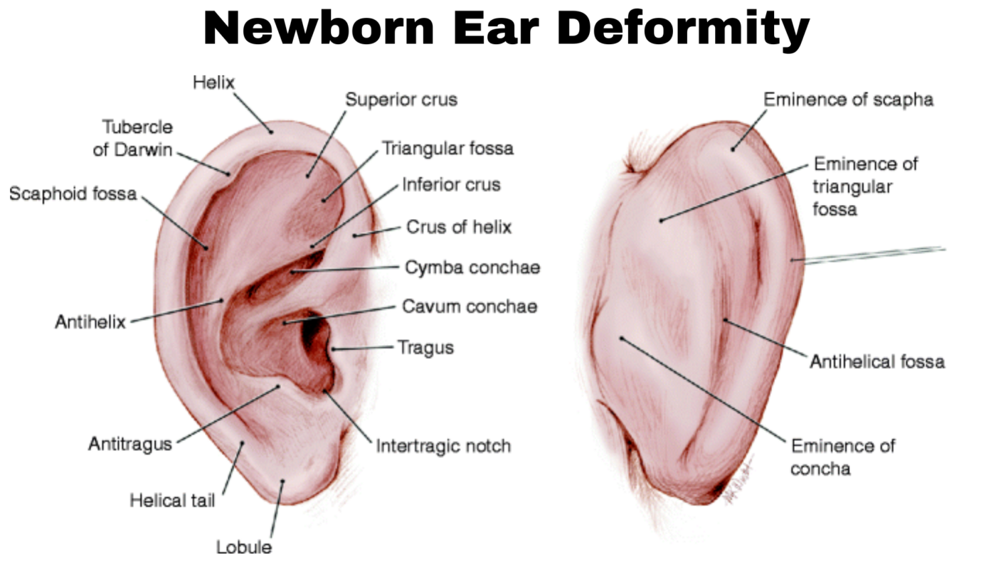 Newborn Ear Deformity