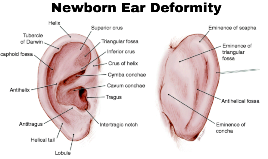 Newborn Ear Deformity with Compassion and Care