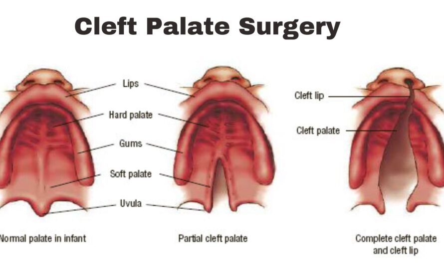 Cleft Palate Surgery Before and After | Cleft Lip and Cleft Palate Repair