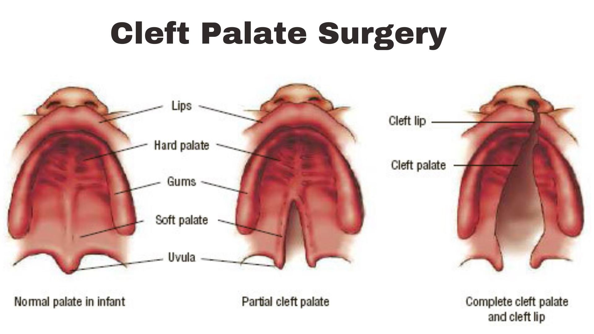 Cleft palate surgery