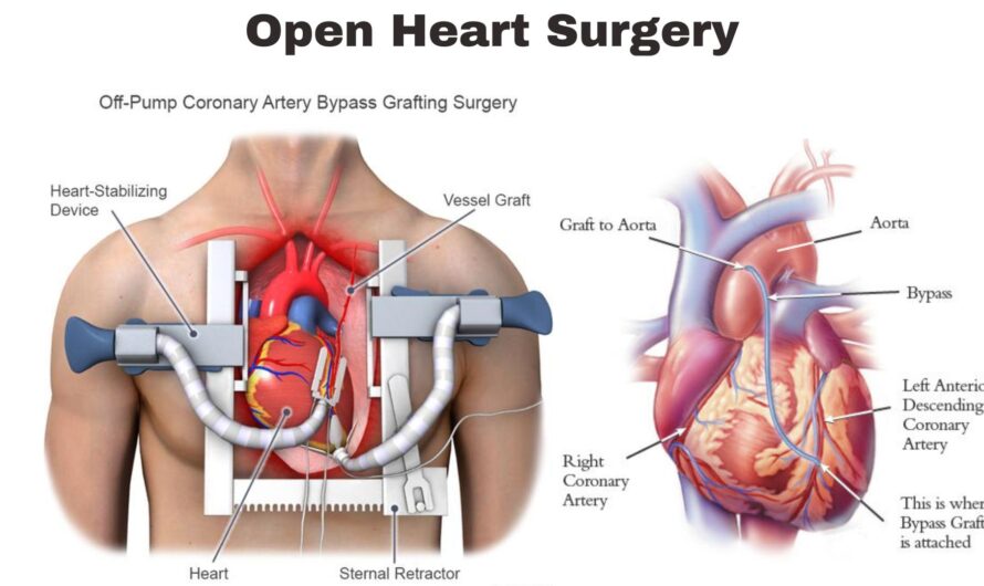 Open Heart Surgery Survival Rate by Age