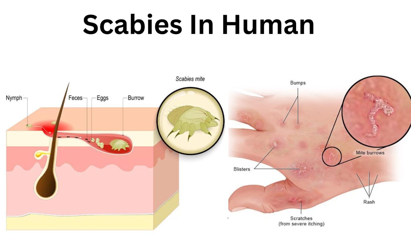 Scabies In Human