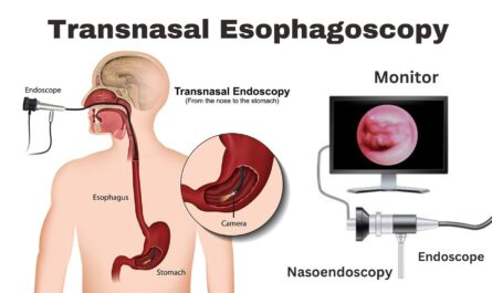 Transnasal Esophagoscopy