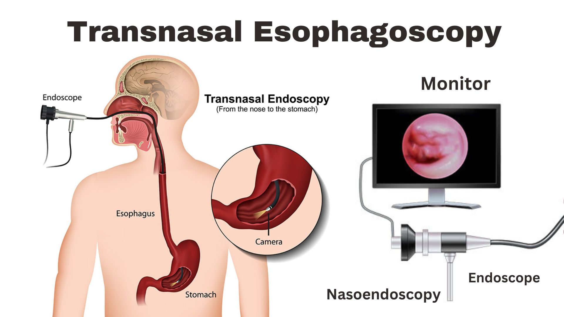 Transnasal Esophagoscopy