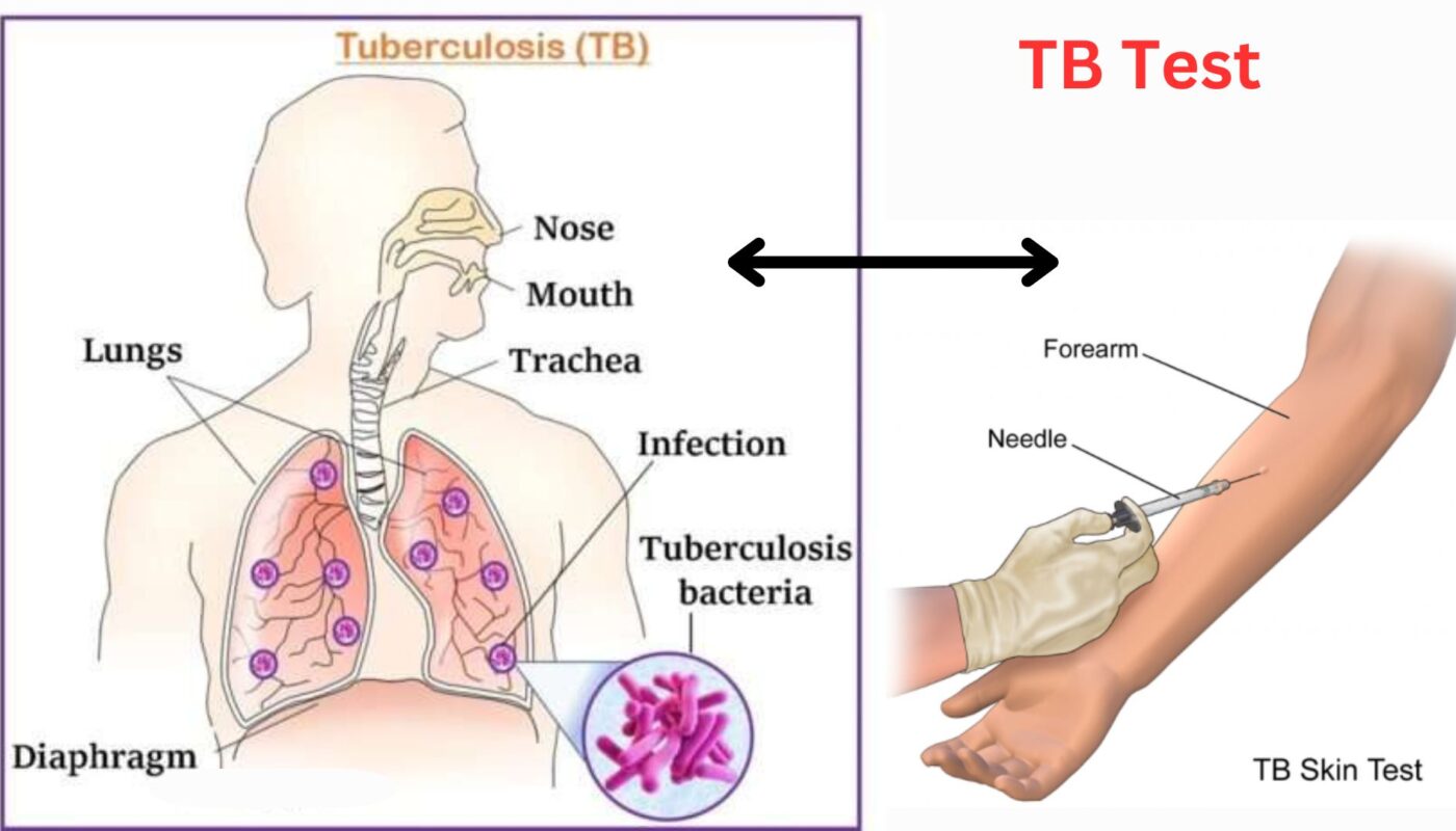 Tuberculosis (TB) test