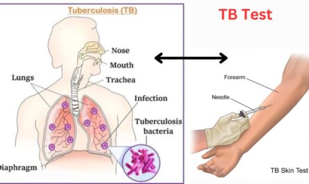 Tuberculosis (TB) test