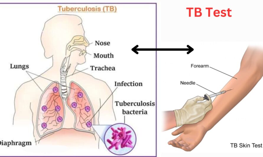 TB Test, Types, Prevention and Control of TB