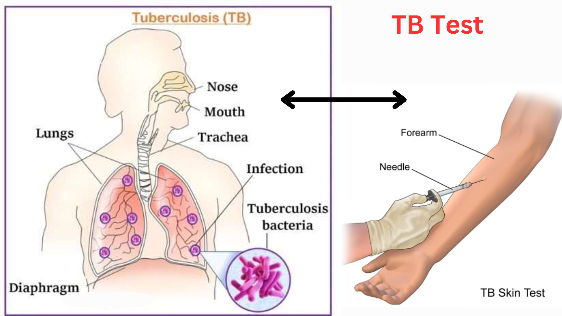 Tuberculosis (TB) test