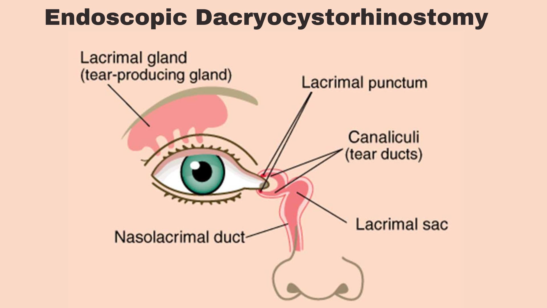 Endoscopic Dacryocystorhinostomy