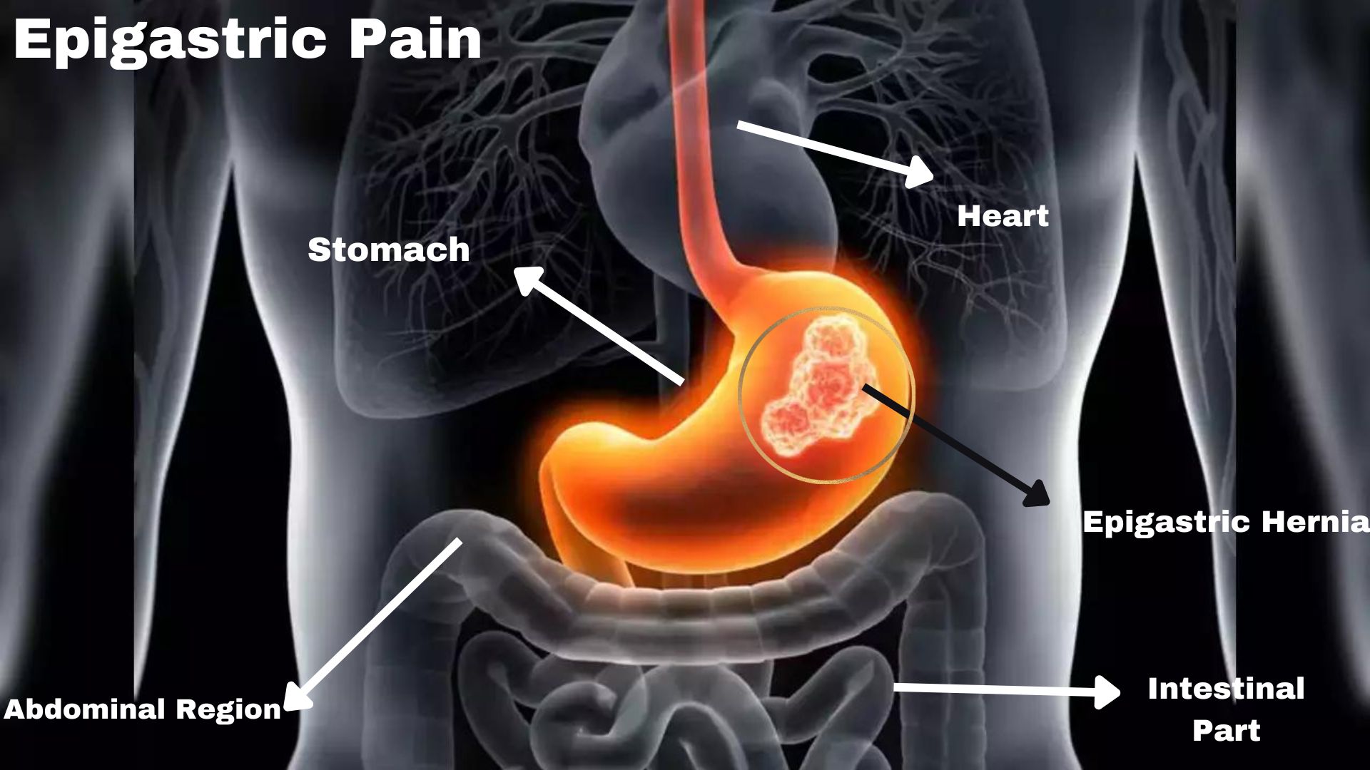 Epigastric Pain ICD 10