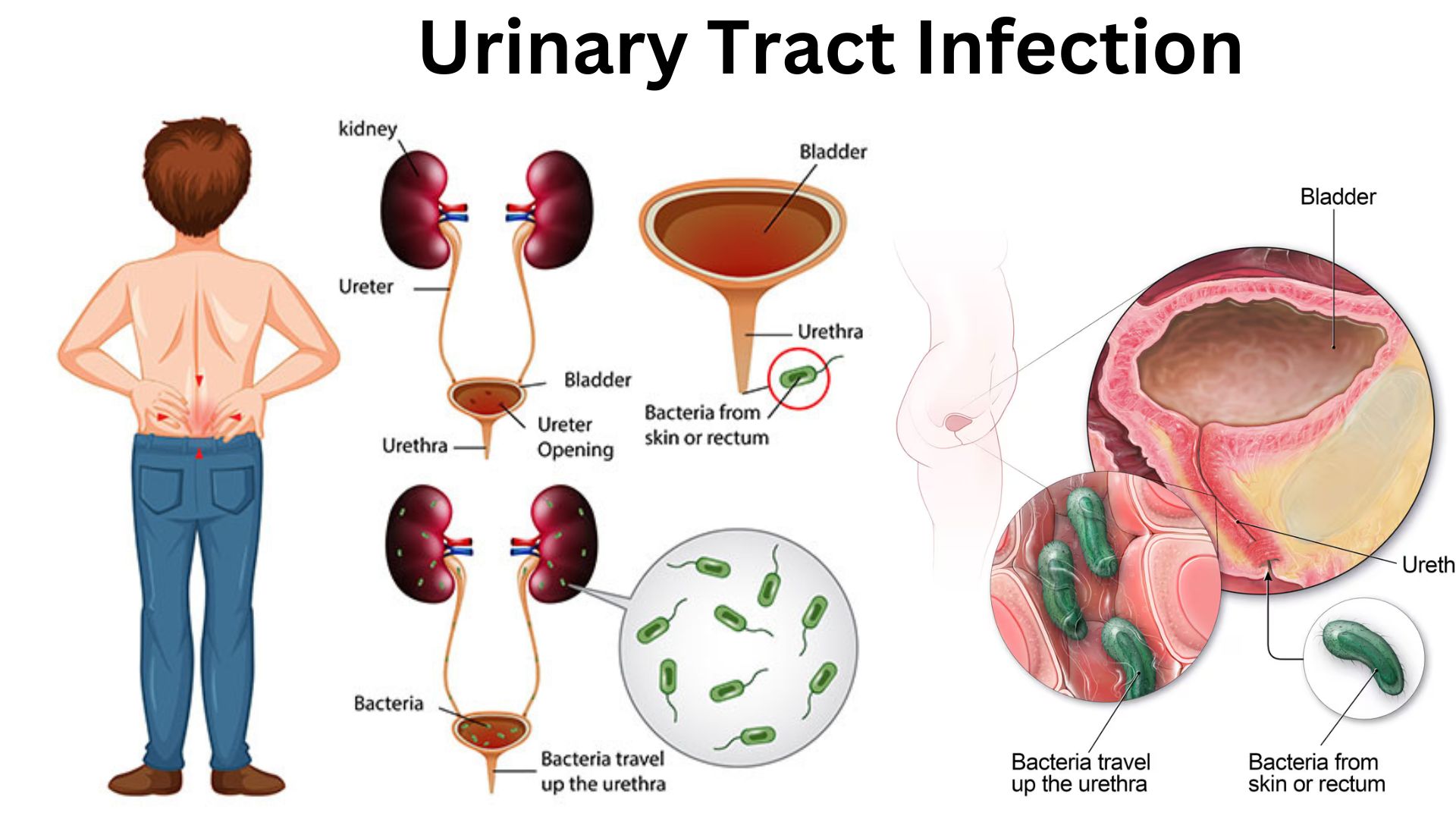 UTI Treatments Over the Counter