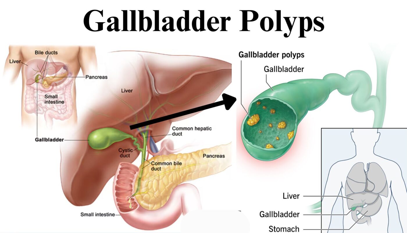 Gallbladder Polyps ICD 10