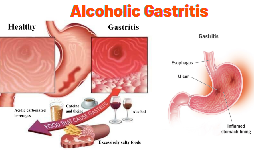 Alcoholic Gastritis Treatment of Proven 5 Ways to Heal Your Stomach Fast