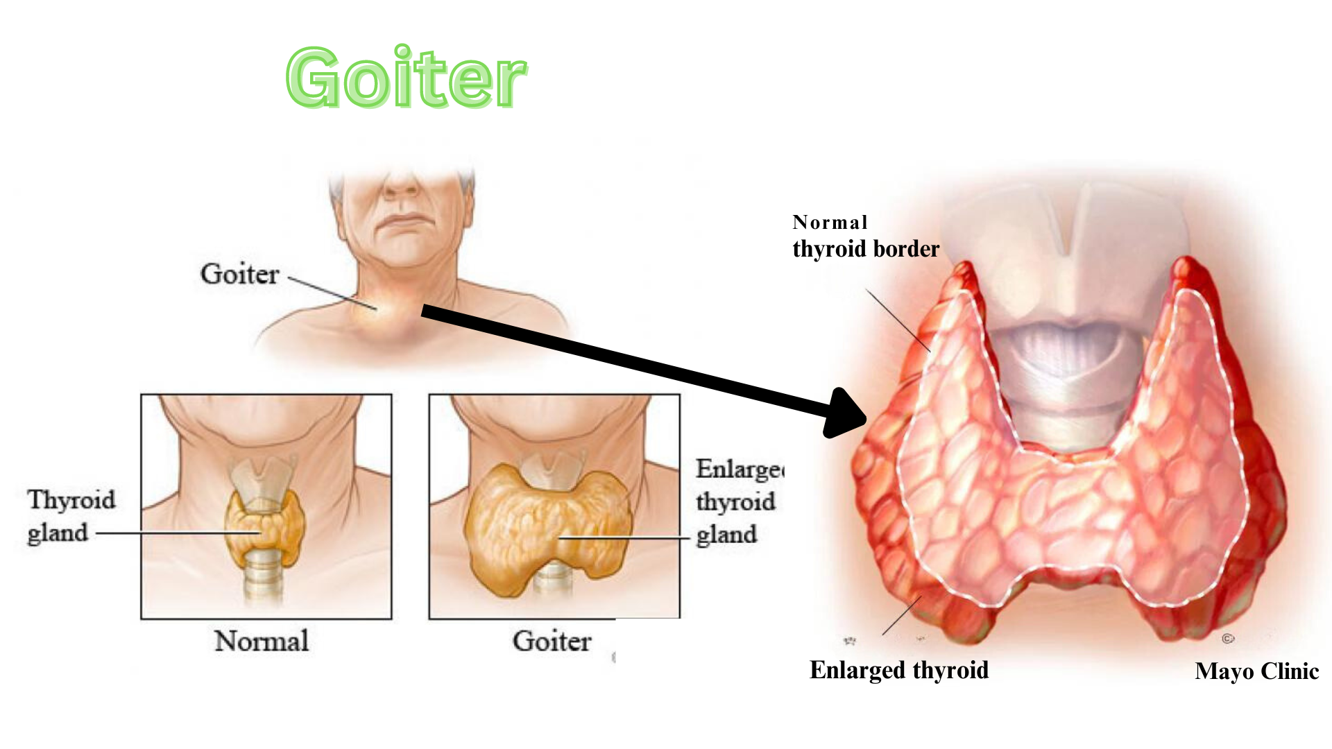 Goiter ICD 10