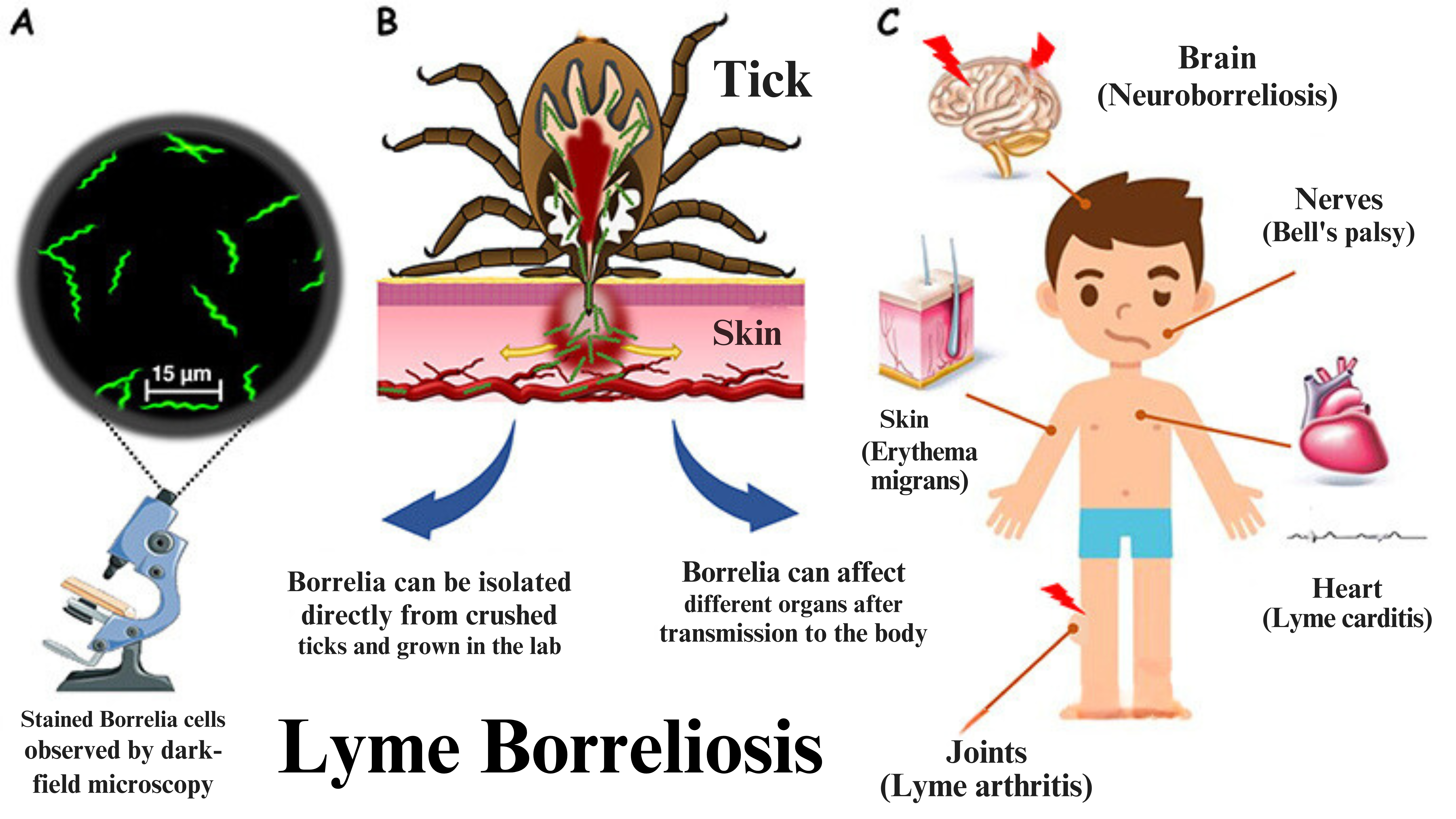 Borreliosis