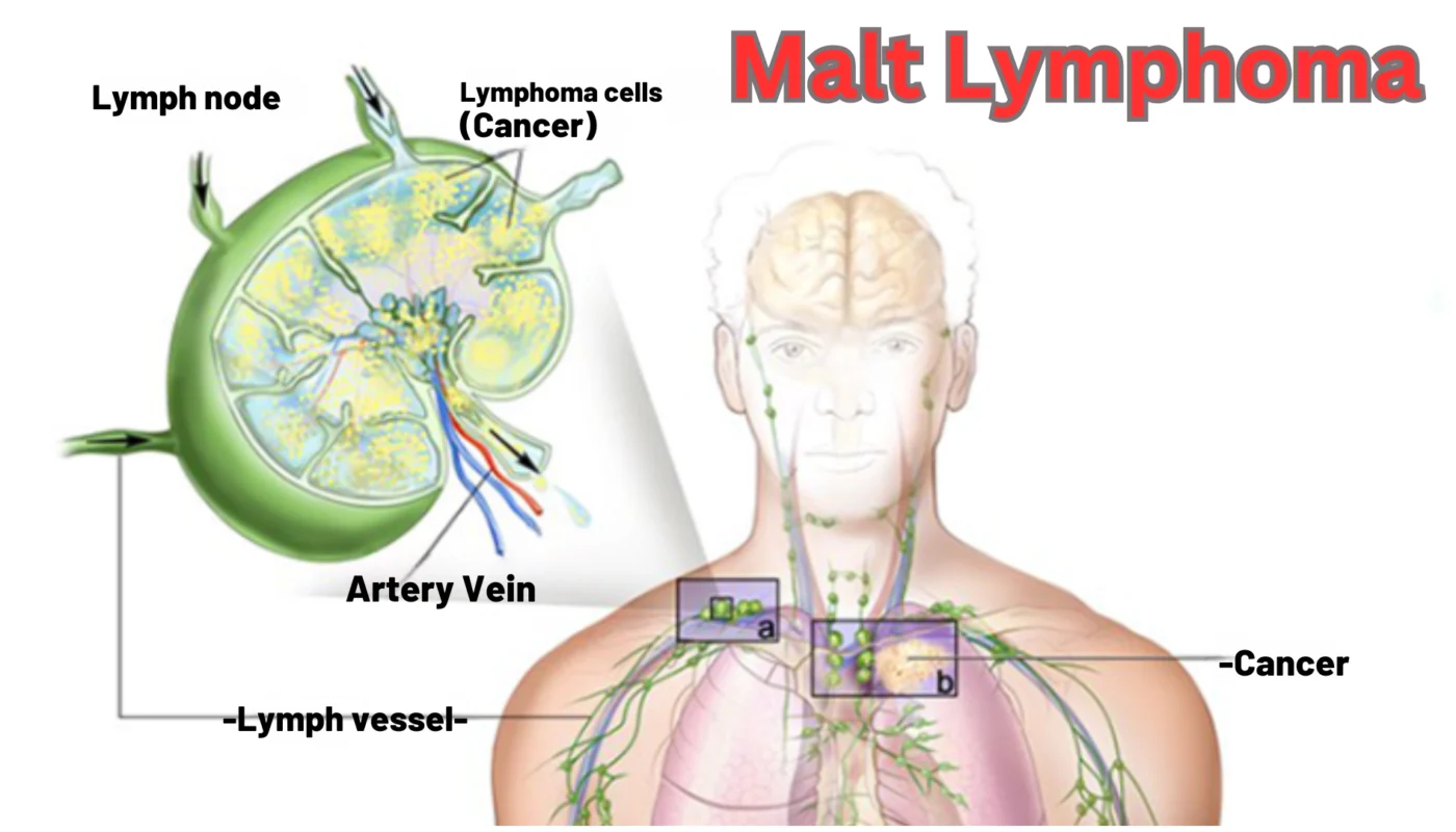 Malt Lymphoma