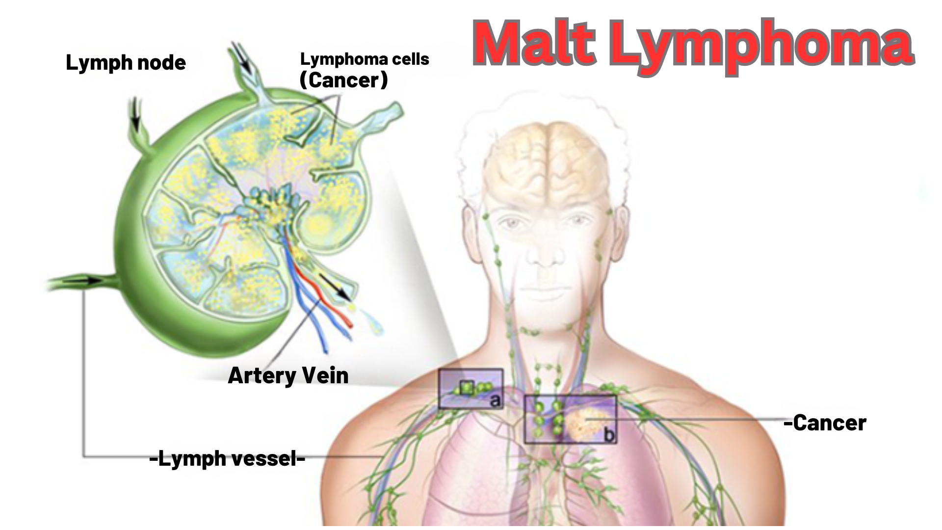 Malt Lymphoma