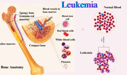 CMML Leukemia