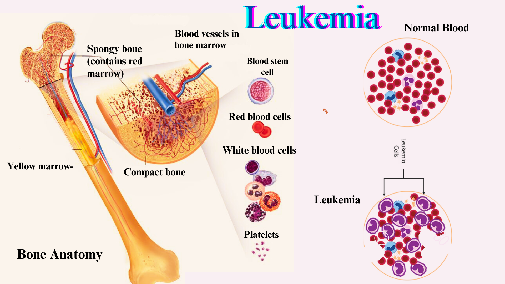 CMML Leukemia