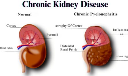 Ozempic Chronic Kidney Disease