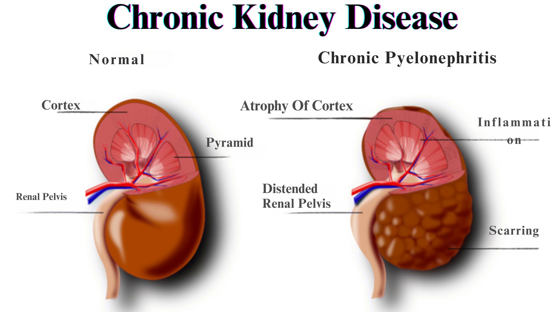 Ozempic Chronic Kidney Disease